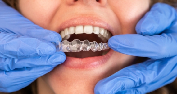 Invisalign en Gijón