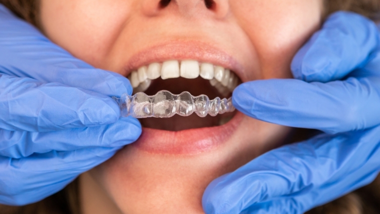 Invisalign en Gijón