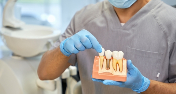 Implantes dentales en Gijón