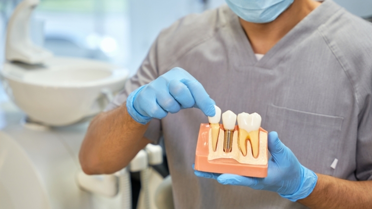 Implantes dentales en Gijón